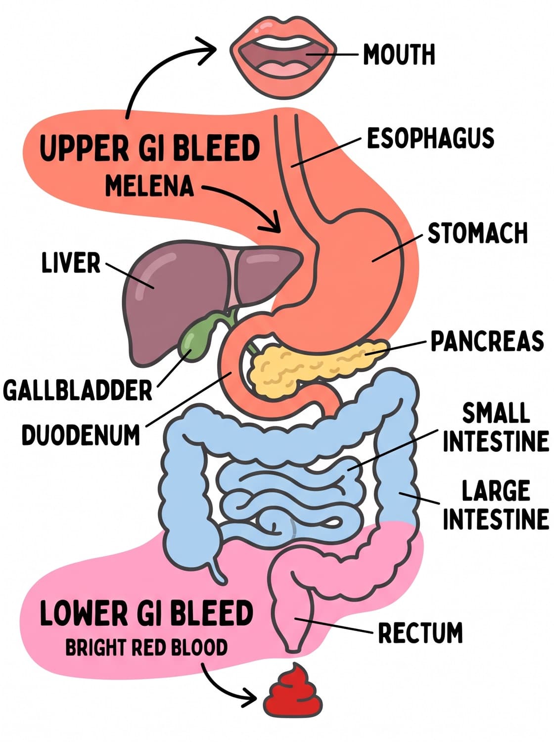 The gastrointestinal tract with the upper bleed zone and lower bleed zone marked and their characteristic stool findings.