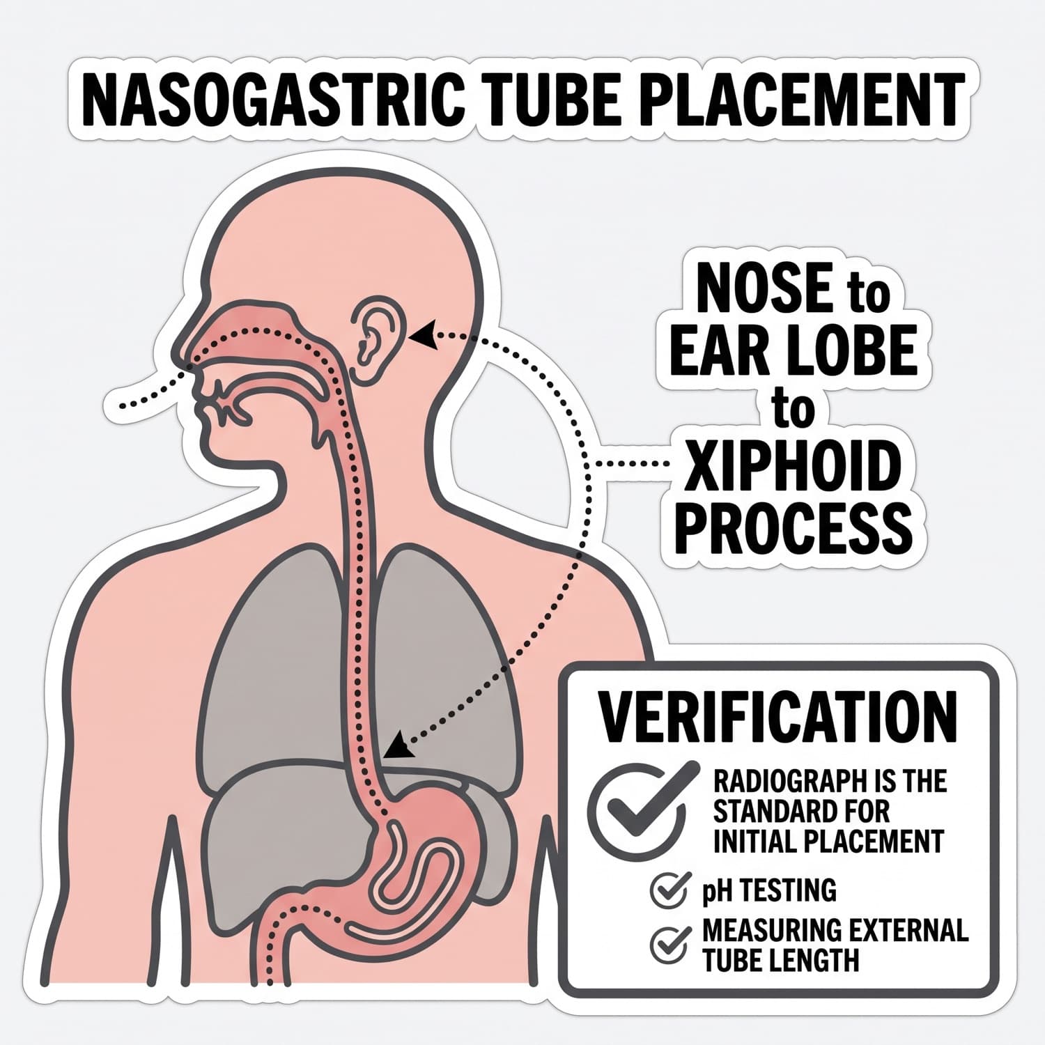 Nasogastric tube placement with the measurement method and the verification standard.