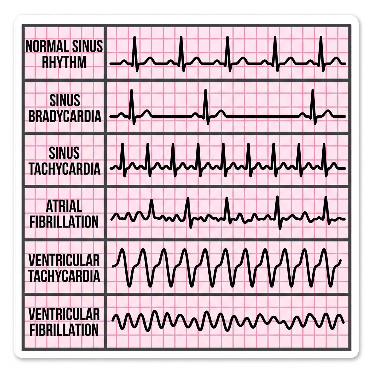 Six labelled rhythm strips: normal sinus, sinus bradycardia, sinus tachycardia, atrial fibrillation, ventricular tachycardia and ventricular fibrillation.